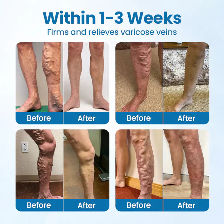 VeinGuard Spray – Visible varicose vein relief in just 7 days!