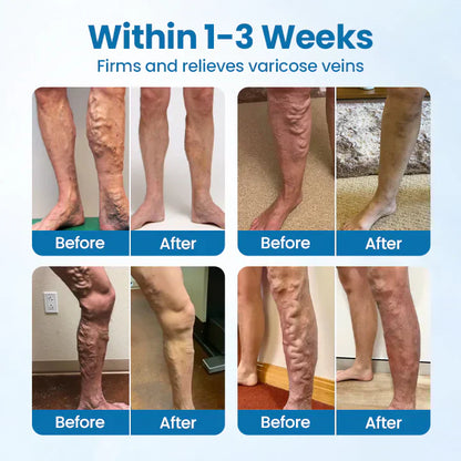 VeinGuard Spray – Visible varicose vein relief in just 7 days!