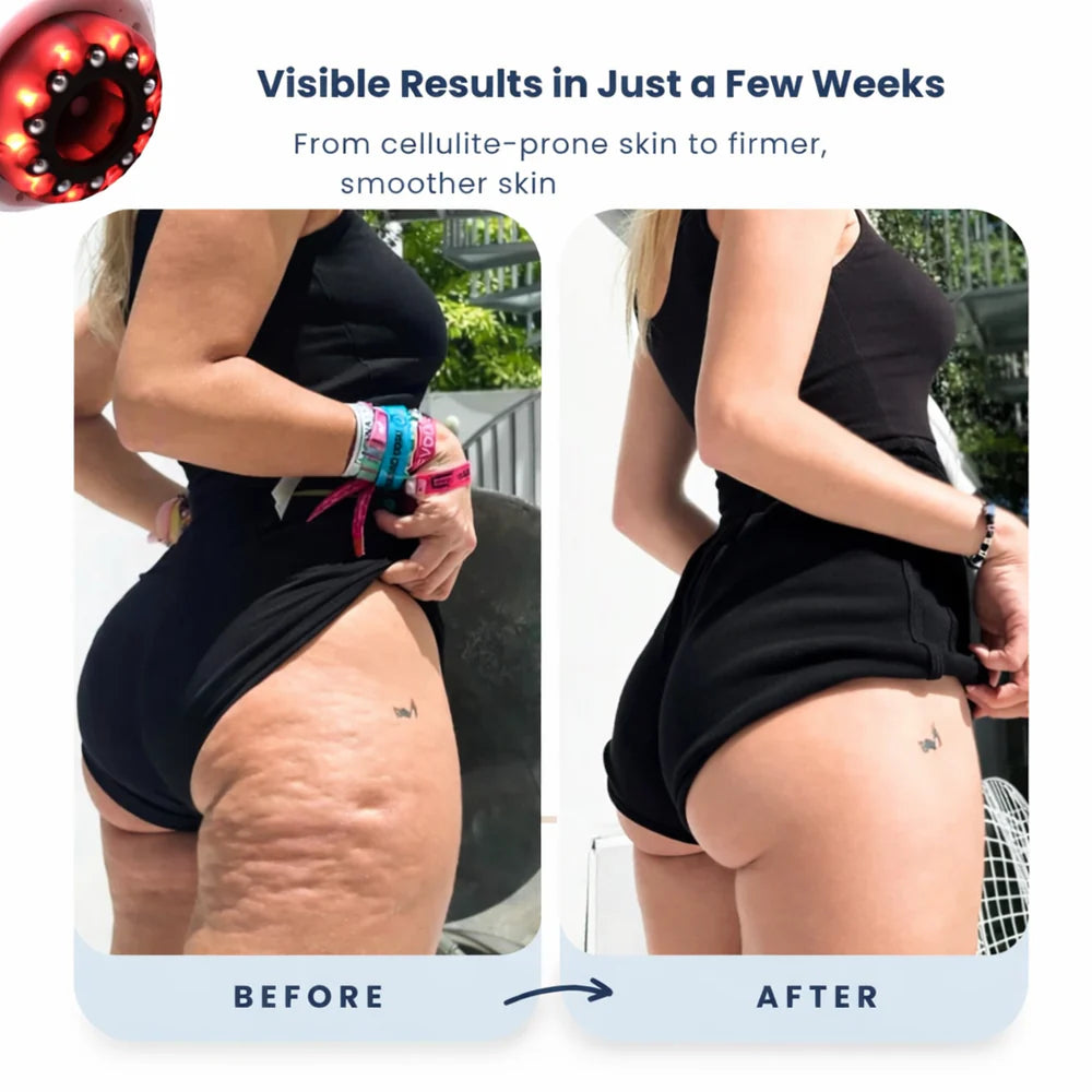 Anti-Cellulite Massager