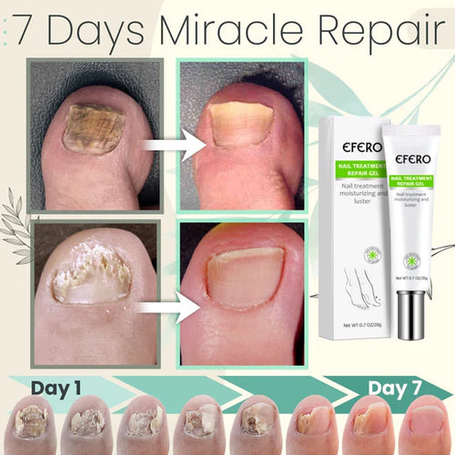 Flyles™Nail Repair Treatment Gel