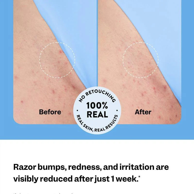 Ingrown Hair Treatment